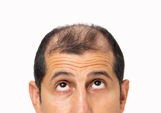 hair loss